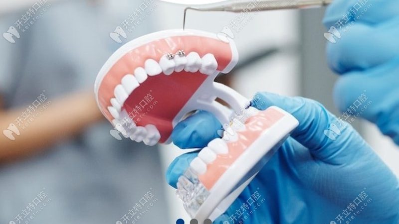 烤瓷牙批发与零售的价差到底藏在哪